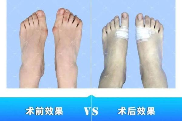 拇外翻:女人的命运与健康的关系揭秘 拇外翻:女人的命运与健康的关系揭秘