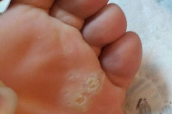 揭秘脚底黑点的含义:如何解读你脚下的秘密命运 揭秘脚底黑点的含义:如何解读你脚下的秘密命运