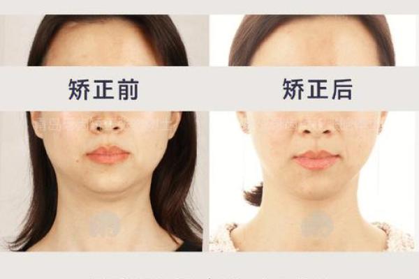 下巴严重后缩的影响与改善方法探讨,重拾自信人生! 下巴严重后缩的影响与改善方法探讨,重拾自信人生!