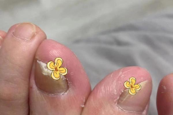 脚趾形状解析:你的命运与脚趾之间的神秘联系 脚趾形状解析:你的命运与脚趾之间的神秘联系