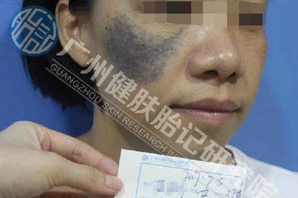 胳膊下有胎记的人生解读：命运与性格的独特关联