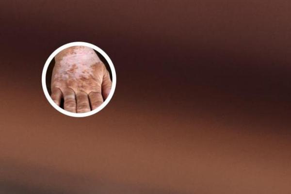 揭秘：后背白斑是何命，背后隐藏的真相！