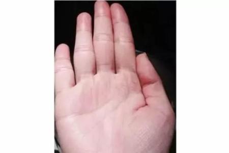 大拇指粗短，每个人的命运都是独特的！