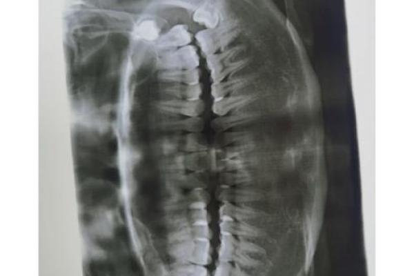 37岁长智齿，命运的转折点与健康启示