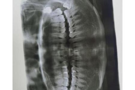 37岁长智齿，命运的转折点与健康启示