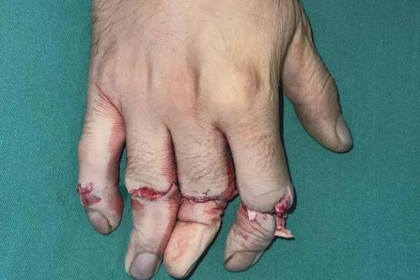 男人左手手指断了,这意味着什么?揭示深藏的命理秘密! 男人左手手指断了,这意味着什么?揭示深藏的命理秘密!