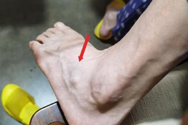你知道脚突出骨头是什么命？探寻这一现象的背后原因与影响
