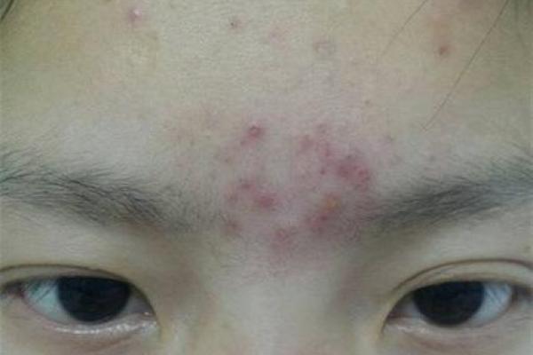 眉心长痘,藏着你的命运秘密与美丽哲学 眉心长痘,藏着你的命运秘密与美丽哲学