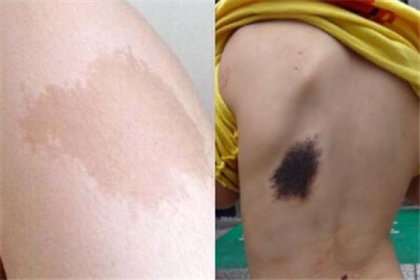 探秘命理:屁股左边胎记的神秘含义与人生影响 探秘命理:屁股左边胎记的神秘含义与人生影响