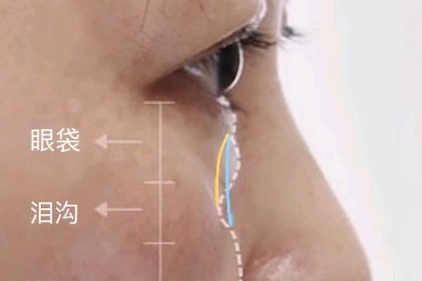 女人眼眶深凹的秘密：揭示内在情感与命运之联系