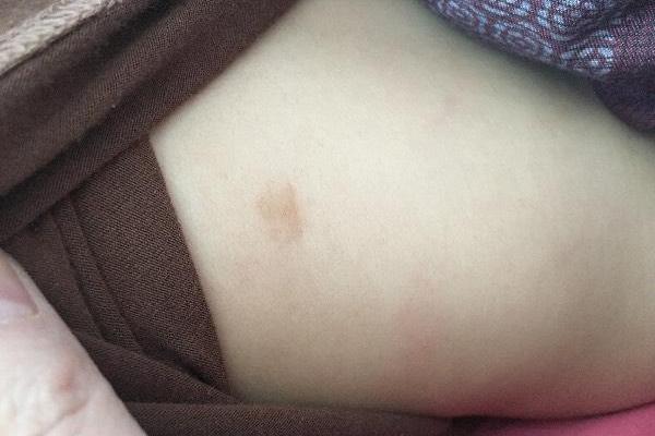 背部胎记的命运解读：你是否与命运有着千丝万缕的联系？