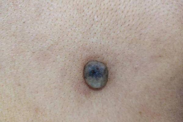 解读左脚下的黑点:命运与健康的隐藏密码 解读左脚下的黑点:命运与健康的隐藏密码