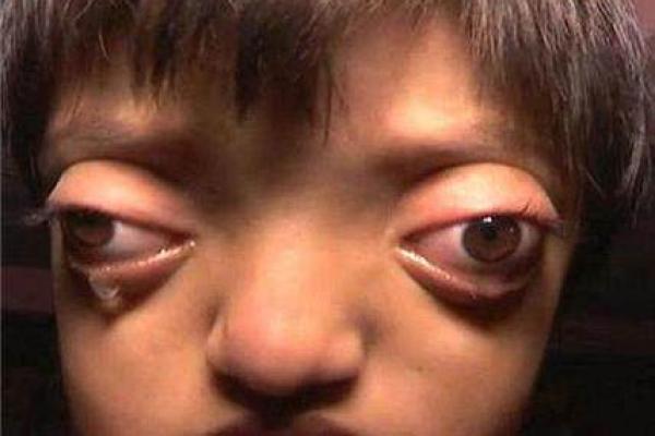 面部畸形与命运:生活中的挑战与希望 面部畸形与命运:生活中的挑战与希望