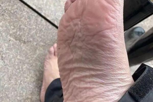 脚心全是皱纹的秘密:揭示命运与健康的深层关联 脚心全是皱纹的秘密:揭示命运与健康的深层关联