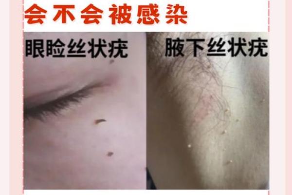 腋下长瘊子解密：你身体告诉你的秘密与命运