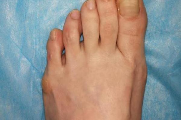 小拇指变形外翻：你不知道的健康秘密与应对策略