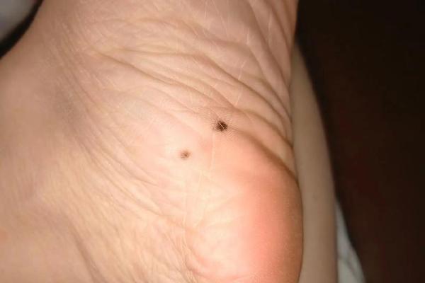 脚底长黑痣：揭示你命运的神秘信号！