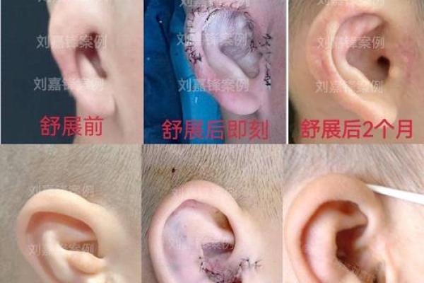 耳廓畸形的人生命运解析:透视耳廓与性格、命运的关系 耳廓畸形的人生命运解析:透视耳廓与性格、命运的关系