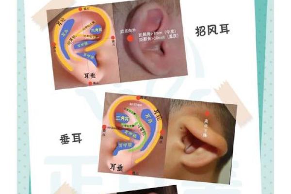 耳廓畸形的人生命运解析:透视耳廓与性格、命运的关系 耳廓畸形的人生命运解析:透视耳廓与性格、命运的关系