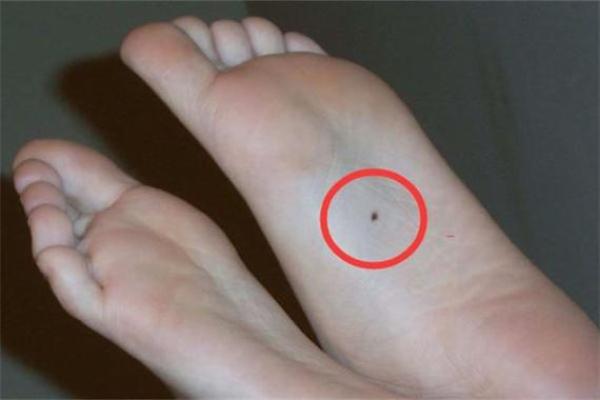 脚底长痣的命理解析:揭示你隐藏的性格与运势 脚底长痣的命理解析:揭示你隐藏的性格与运势