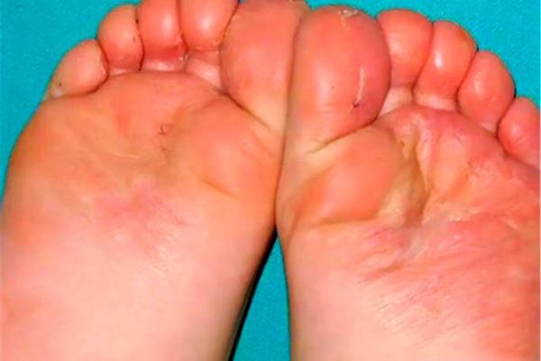 脚底圆圈纹与命运的奇妙关系探析