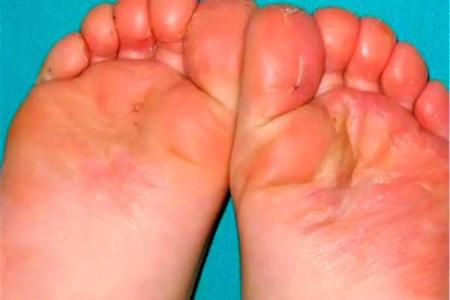 脚底圆圈纹与命运的奇妙关系探析