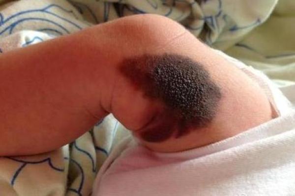 探秘腰部胎记的命理意义与人生象征！