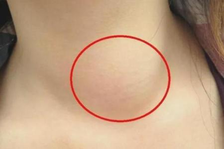 脖子上的痣暗示的命理玄机，揭示你的命运走向！