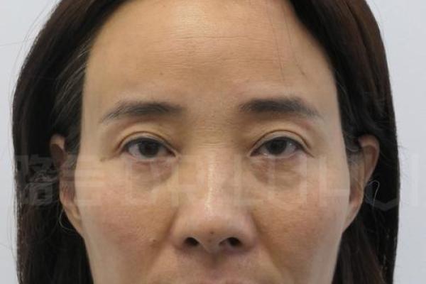 眼袋与皱纹的秘密：揭示面部衰老的真相与解决之道