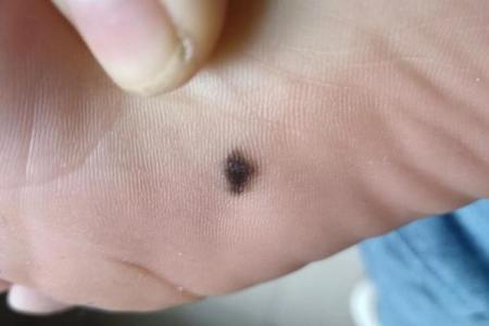 女生脚底有痣的命运解析，揭开命理密码的神秘面纱！