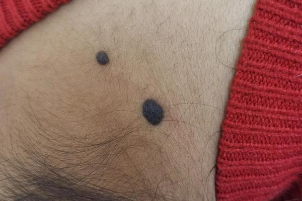 你背心长肉痣，命运暗藏玄机，解读痣相之谜！