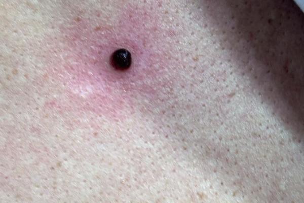 你背心长肉痣，命运暗藏玄机，解读痣相之谜！