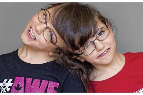 古代连体人命运：奇异生命中的传奇与教训