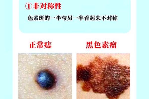 身上的痣与命运的秘密:探寻痣相学的神秘世界 身上的痣与命运的秘密:探寻痣相学的神秘世界